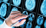 Padaczka - lekarz analizujący wynik badania mózgu.